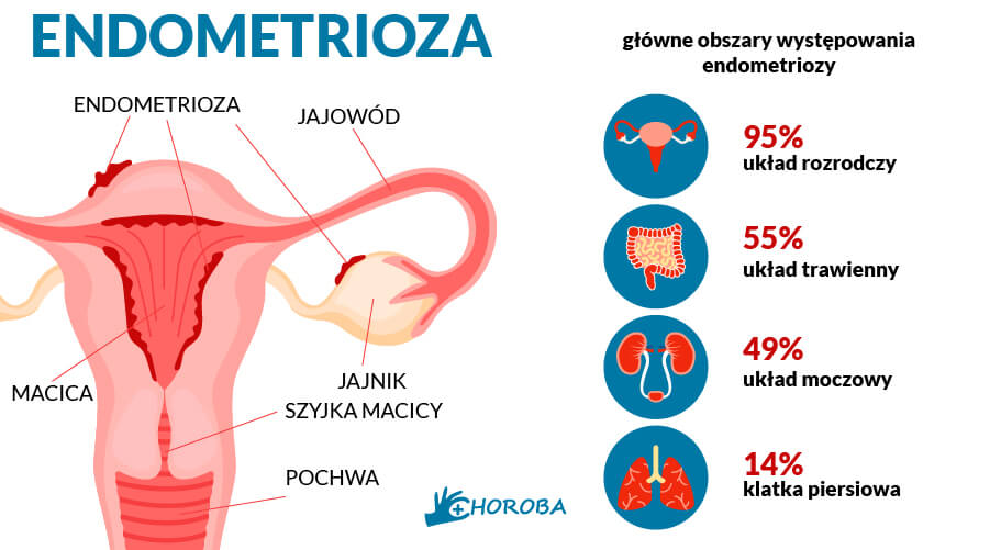 Endometrioza - główne obszary występowania endometriozy